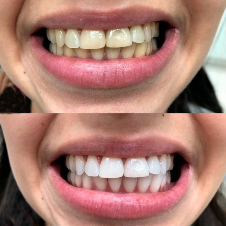 Clareamento Dental S Sorriso Odontologia Recreio Do Bandeirantes