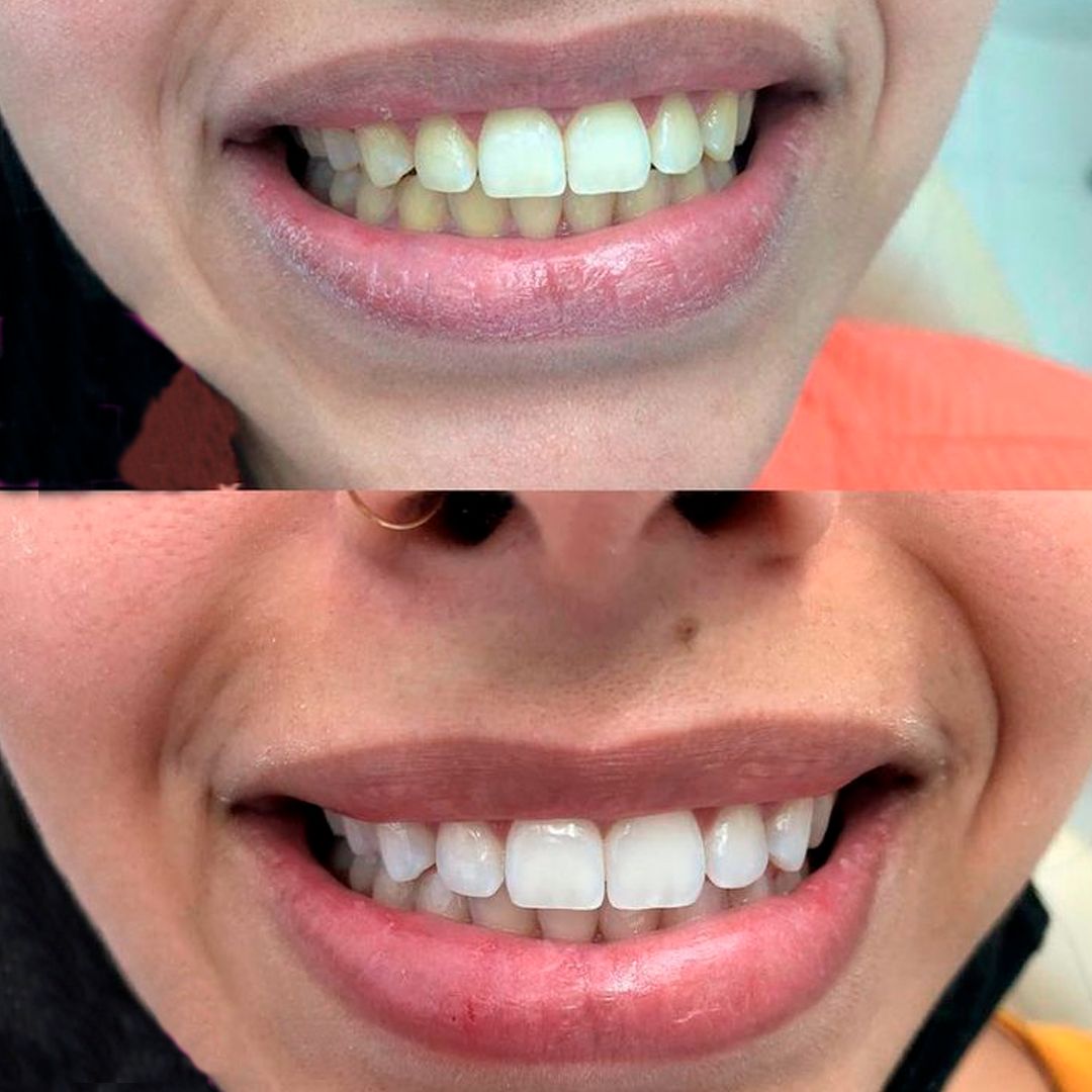 Clareamento Dental S Sorriso Odontologia Recreio Do Bandeirantes